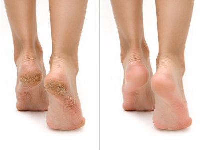 Dry Foot Skin and Cracked Heels: Causes and the Importance of Care